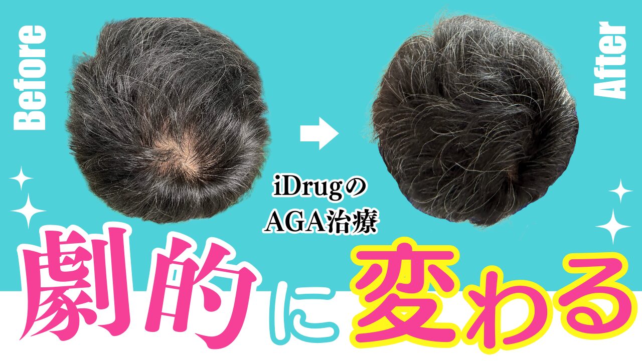 AGA治療